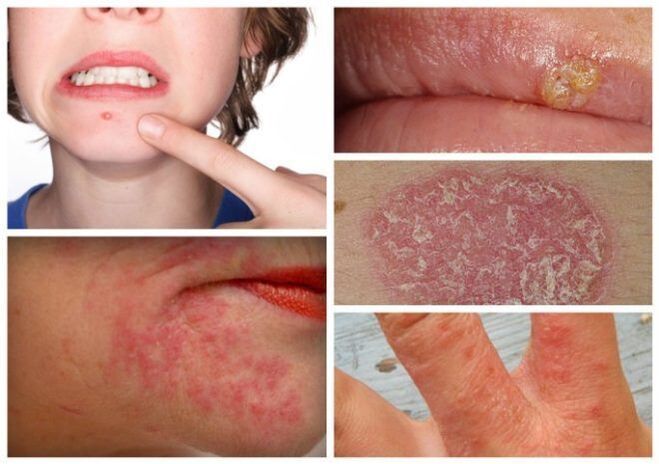 Allergie e malattie della pelle sono segni di parassiti nel corpo