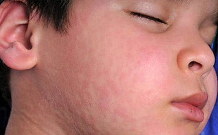 Eruzioni allergiche sulla pelle - un sintomo della presenza di vermi parassiti nel corpo