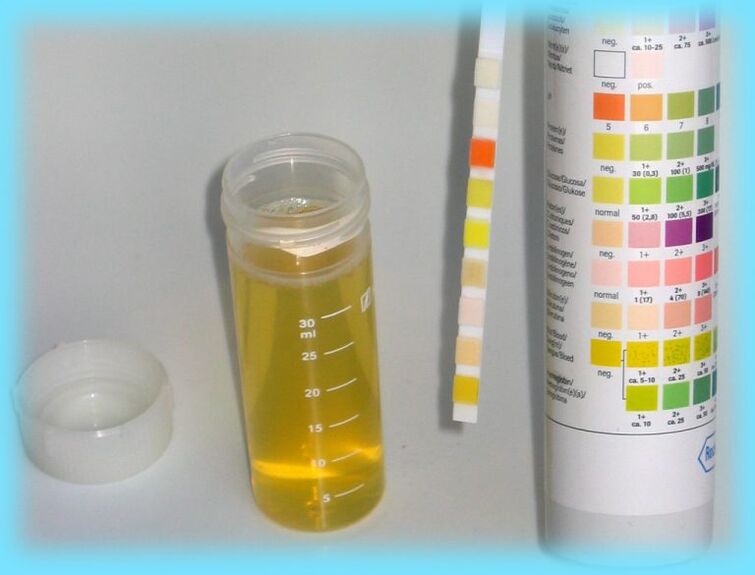 Analisi delle urine